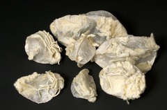 Wool_sorters_disease_anthrax_