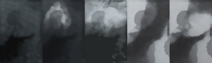 Variation1