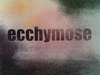 20130315162339-ecchymose_site