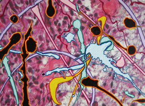 20130323113441-study_for_the__22my_sarcoma_project__22_mixed_media__11_22_x_17_22_2013
